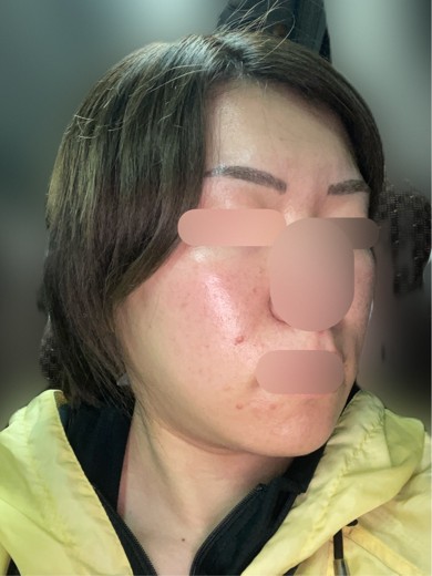 after photo: 脂肪溶解注射(顔)