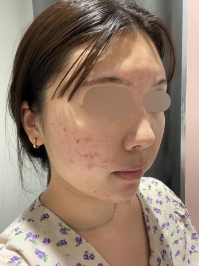 after photo: ピーリング, ララピール(LHAピーリング)