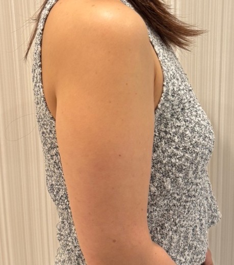 before photo: 脂肪溶解注射(肩)