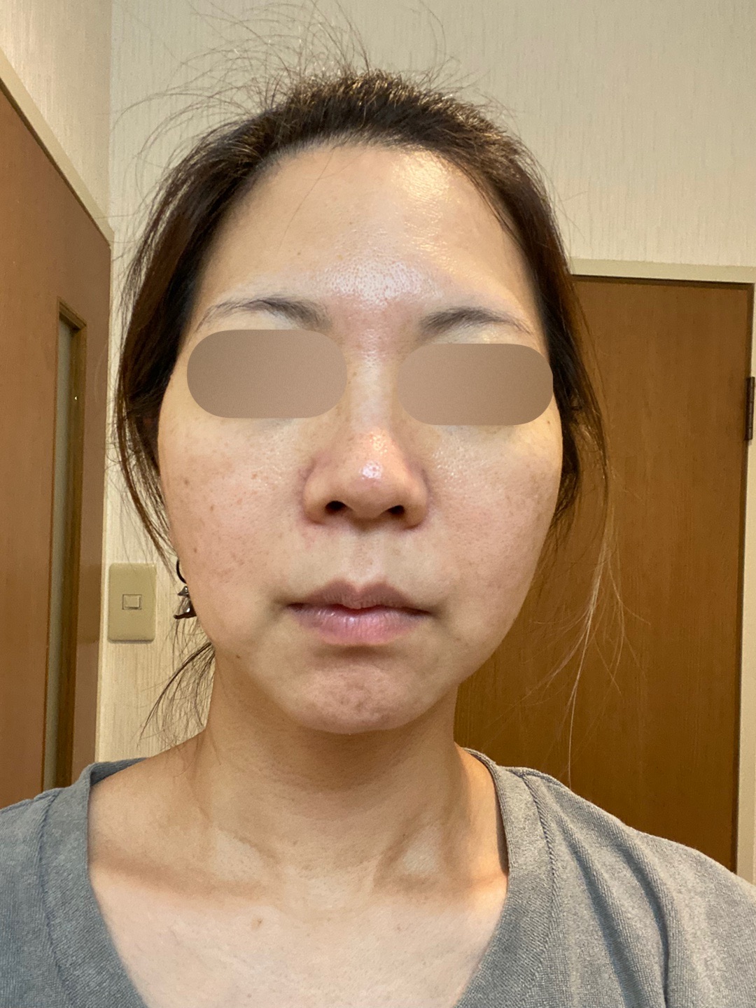 何度でも可】全顔シミ取り放題＋美顔レーザートーニング | ZX-CLINIC