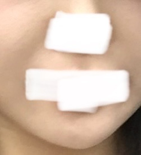 after photo: 팔자주름필러