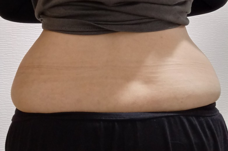after photo: 高周波脂肪溶解(腹部)