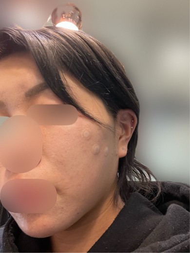 before photo: 脂肪溶解注射(顔)