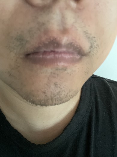 after photo: 턱제모, 인중제모