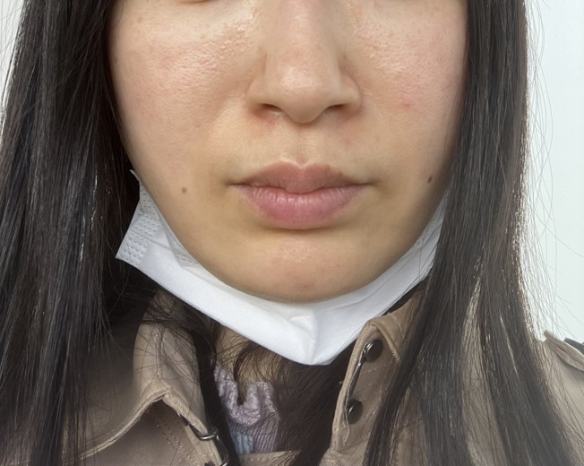 after photo: ジュベルック(Juvelook)