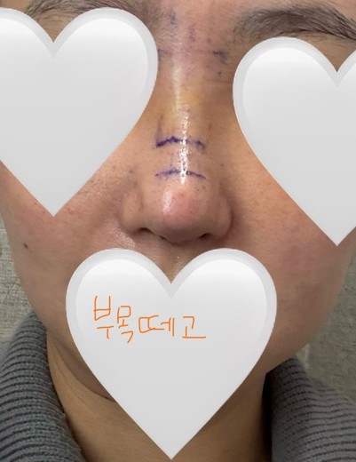after photo: 콧대(보형물), 코끝(자가연골)