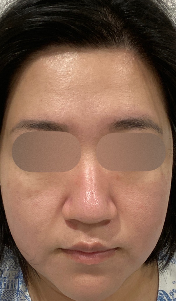 2023年最新エレクトロポレーション　ハイドラフェイシャル 2023年最新エレクトロポレーション ハイドラフェイシャル