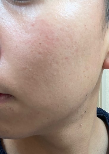 after photo: ダーマペン
