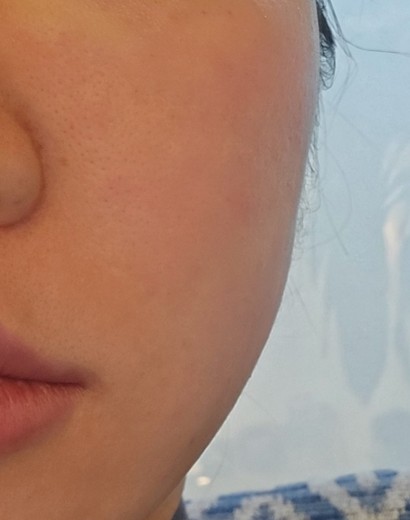 after photo: 포트라리프팅