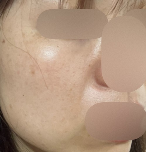 after photo: レーザートーニング, 診断・検査