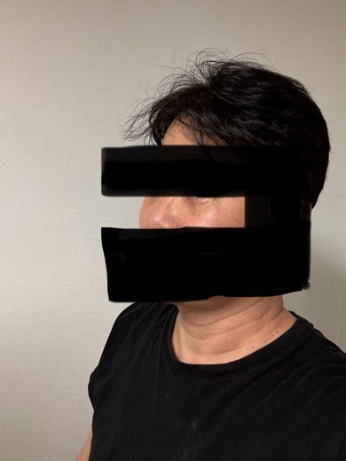 after photo: 눈밑지방재배치