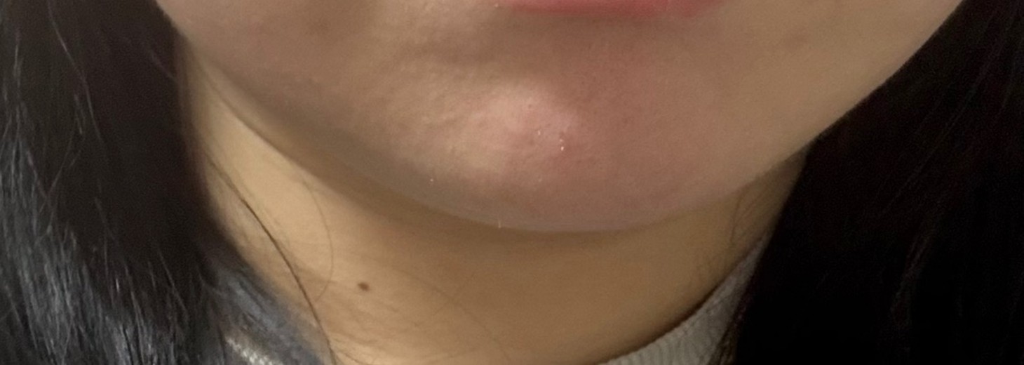 after photo: 윤곽주사