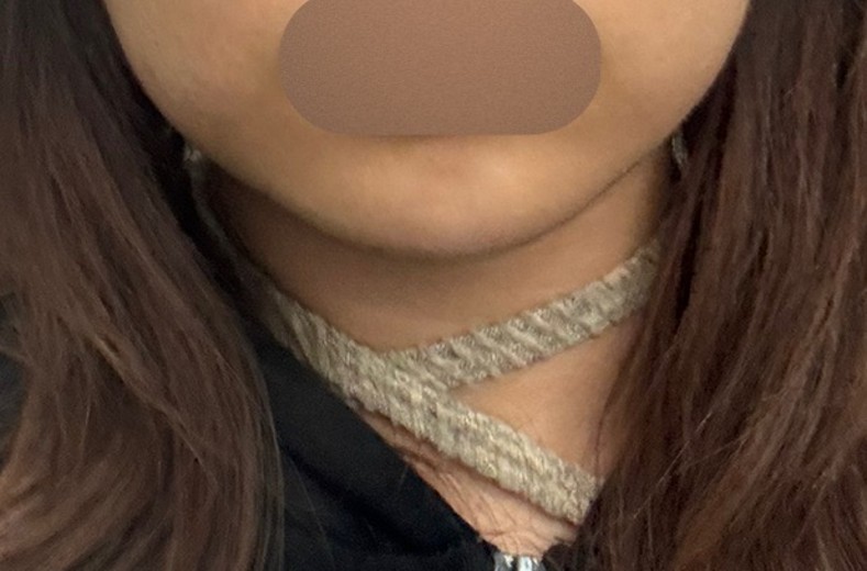 before photo: 턱끝필러