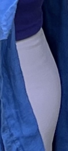 before photo: 팔지방흡입, 옆구리지방흡입, 복부지방흡입, 허리지방흡입