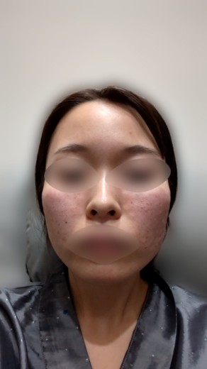 after photo: 脂肪溶解注射(腕), 脂肪溶解注射(太もも)