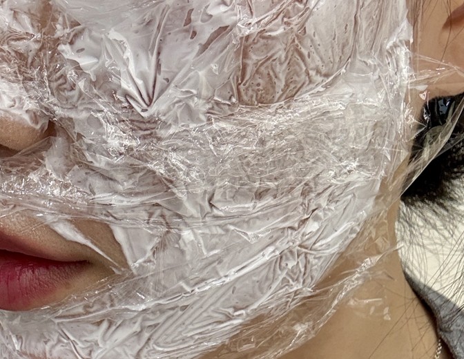 after photo: 리쥬란힐러