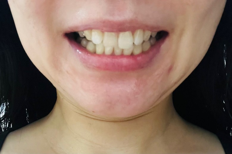 after photo: ホワイトニング