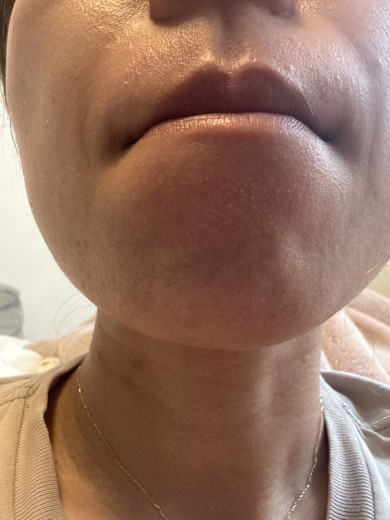 after photo: ルメッカ