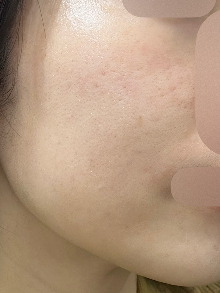 カンナム限定！ララピール＋LDM水玉リフティング！【再来OK