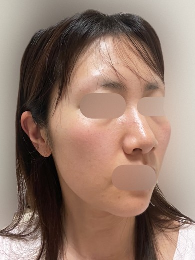 after photo: ルメッカ