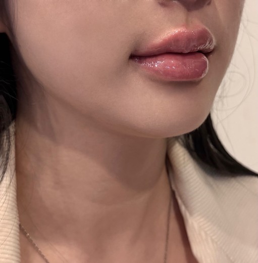 after photo: 입술필러