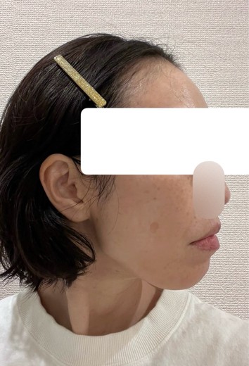after photo: ウルトラフォーマー3(ハイフ)