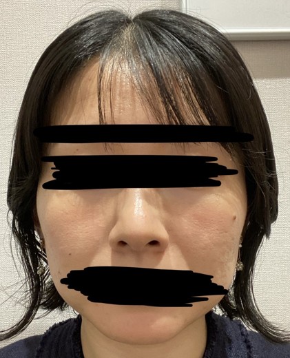 before photo: 白玉注射・点滴
