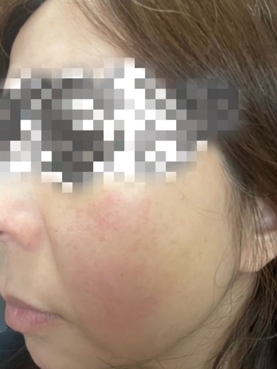 after photo: ピーリング, ルメッカ
