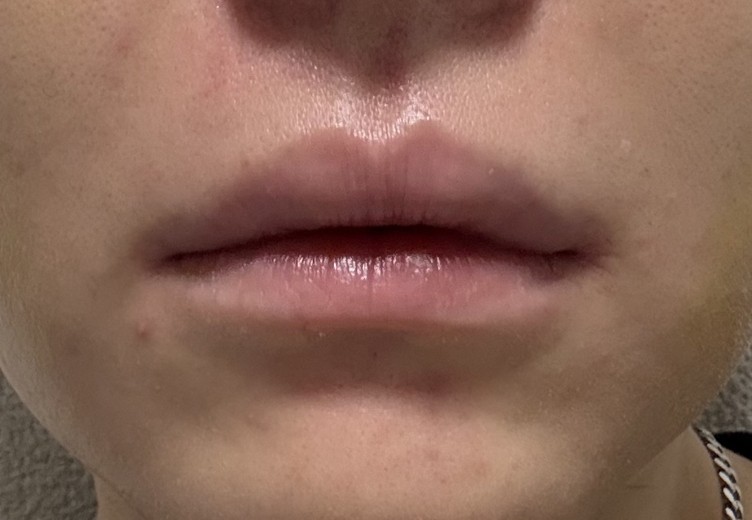 after photo: 脂肪溶解注射(顔)