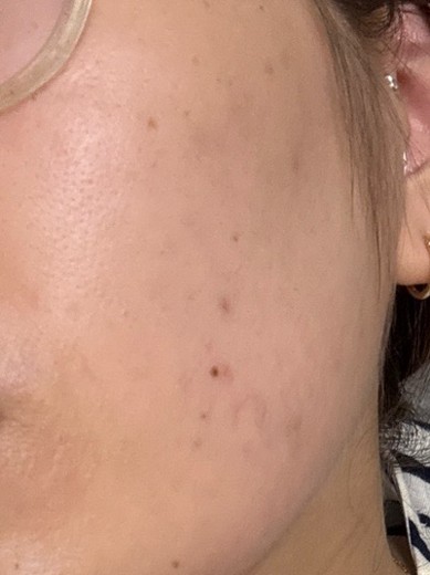 after photo: IPL(光/フォト治療), ハイドラジェントル