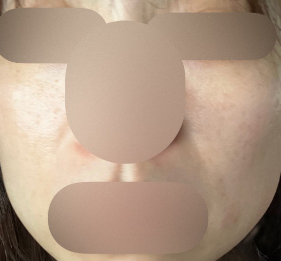 before photo: レーザートーニング, 診断・検査