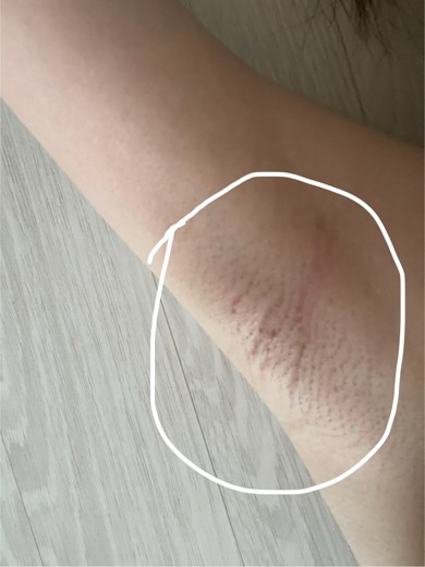 after photo: 겨드랑이제모