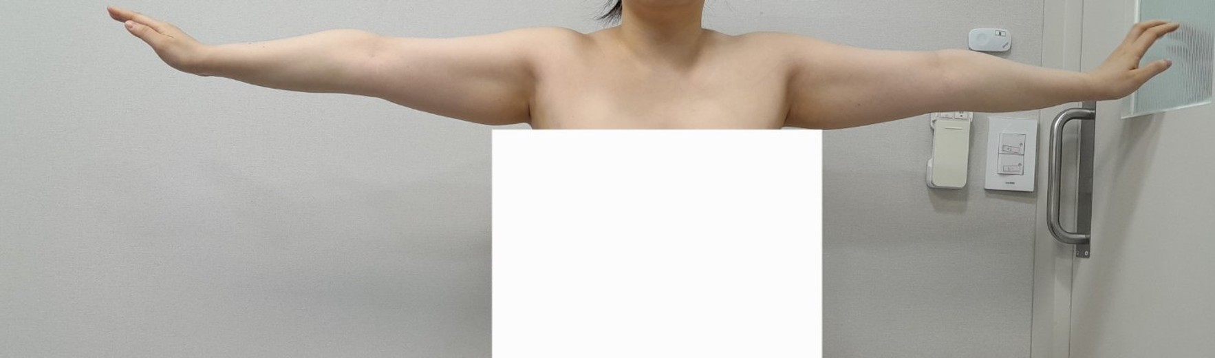 before photo: 脂肪吸引(腕)