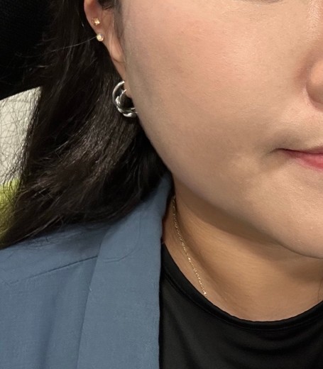 after photo: 윤곽주사