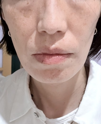 after photo: IPL(光/フォト治療)