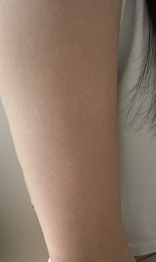 after photo: 팔지방분해주사