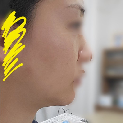 after photo: リニアファーム(ハイフ)
