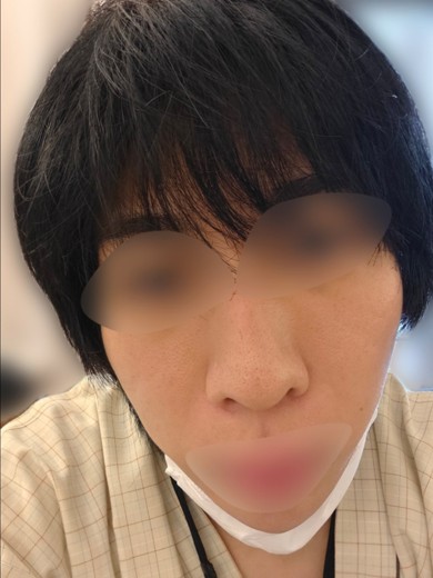 after photo: ポテンツァ(POTENZA), 診断・検査, ジュベルック(Juvelook)