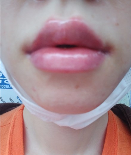 after photo: 입술필러
