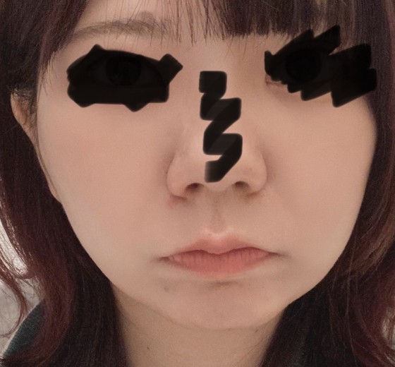 after photo: 糸リフト