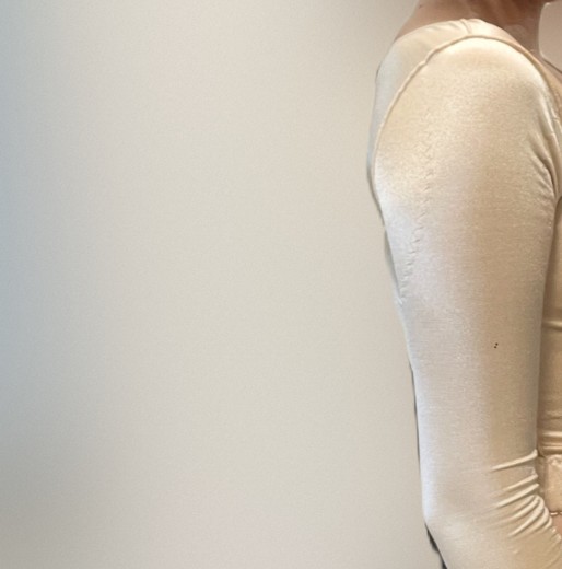 before photo: 팔지방흡입, 부유방흡입