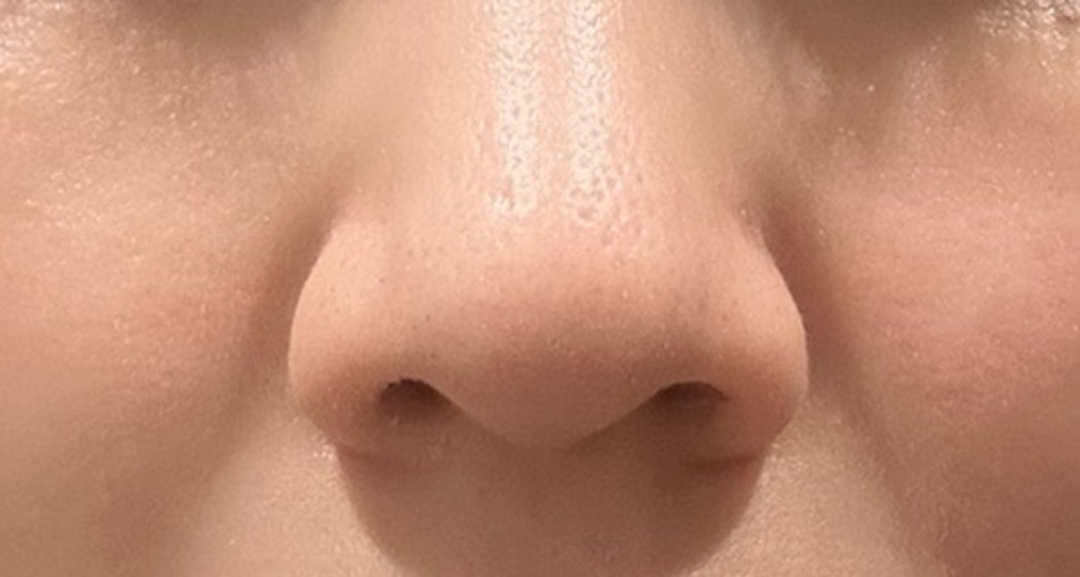 before photo: 脂肪溶解注射(顔)