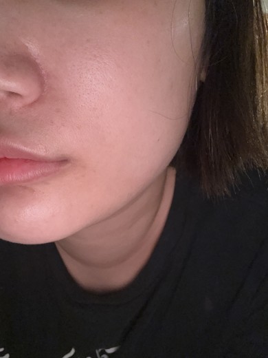 after photo: 앞광대필러