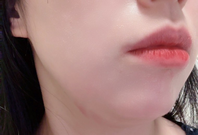 after photo: 脂肪溶解注射(顔)