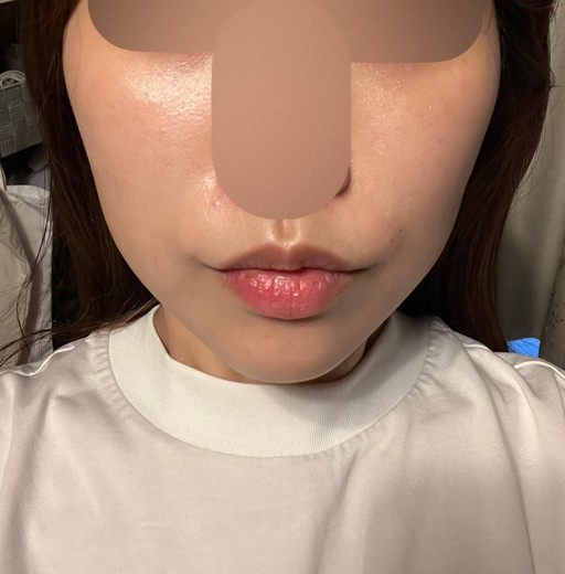 after photo: 糸リフト