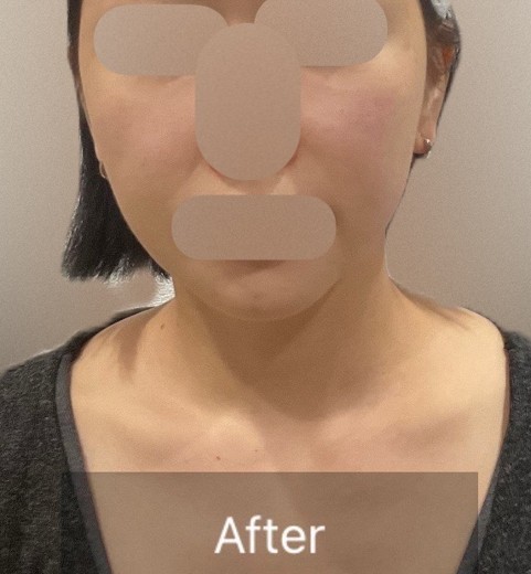 after photo: チタニウムリフト, マッサージピール(コラーゲンピール)