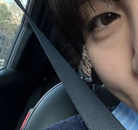 after photo: 보조개성형