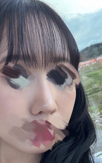 after photo: 콧대(자가조직), 코끝(자가연골)