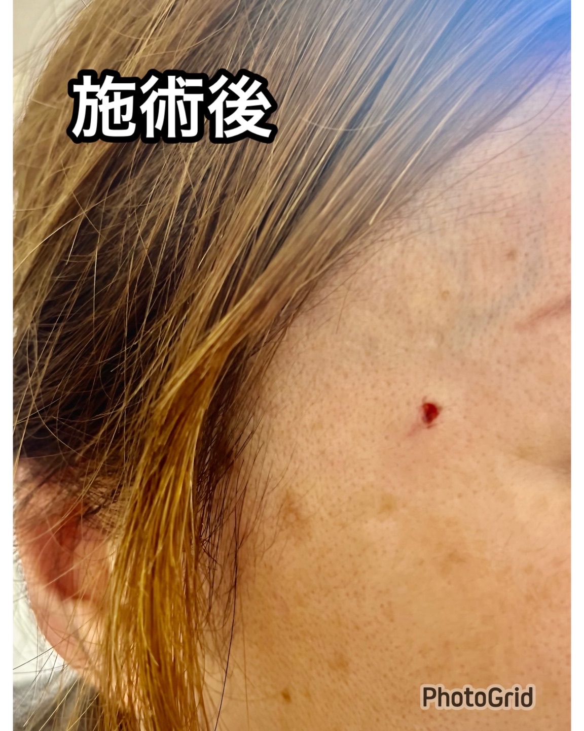 ホクロ取り1個（4-5mm程度以下のもの）｜麻酔込み | 血管外科