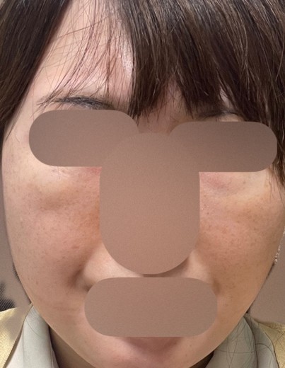 before photo: ミラノリピール